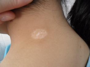 武汉白点毕环亚