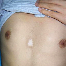 武汉医院治白环亚夸