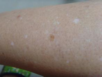 武汉医院治白环亚出彩