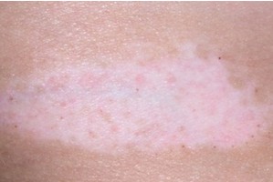 武汉白癫丰环亚