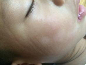 武汉女孩身上长了白癜风怎么回事