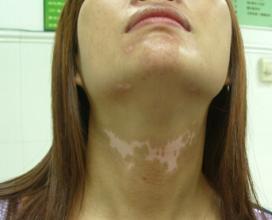 武汉女性有白癜风怎么治疗效果好