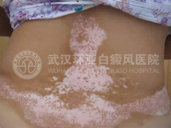 散发型白癜风1.jpg