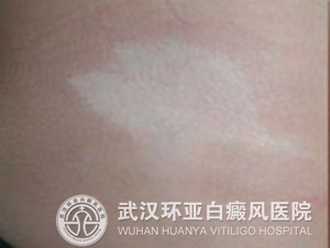 散发型白癜风可以痊愈吗 1.jpg