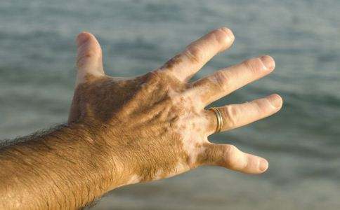 手臂白癜风到底有什么特征呢? 手臂白癜风到底有什么特征呢?