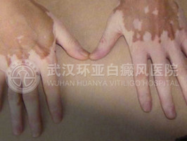 肢端型白癜风.jpg